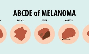 New AI Model Sets Benchmark in Skin Cancer Detection with 99.8% Accuracy