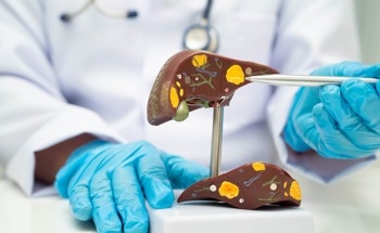 AI Model Detects Fatty Liver Disease from Chest X-Rays with Over 80% Accuracy