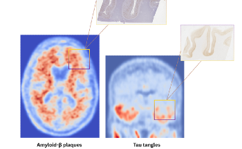 New AI Tool Accurately Forecasts Alzheimer’s Proteins