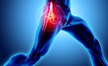 Pin-Free Robotic Surgery Reduces Risk in Joint Replacements