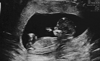 MIT Introduces First Articulated 3D Model of the Fetus, Advancing MRI-Based Prenatal Assessment
