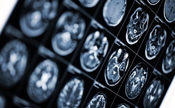 Surgeons Test Contactless System That Matches SEEG Accuracy in a Fraction of the Time