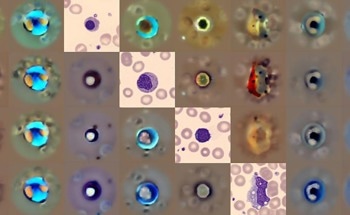 AI Detects Abnormal Blood Cells More Accurately and Knows When to Ask for Help