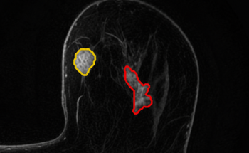Quibim Launches CE and UKCA-Marked QP-Breast®, the First AI Tool to Detect Breast Cancer via MRI in Europe and the UK